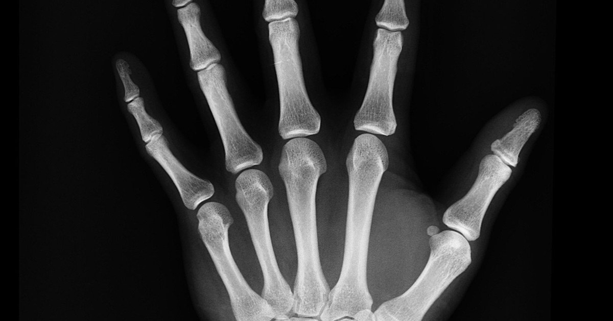 An X-ray of a healthy human hand showing the finger and palm bones