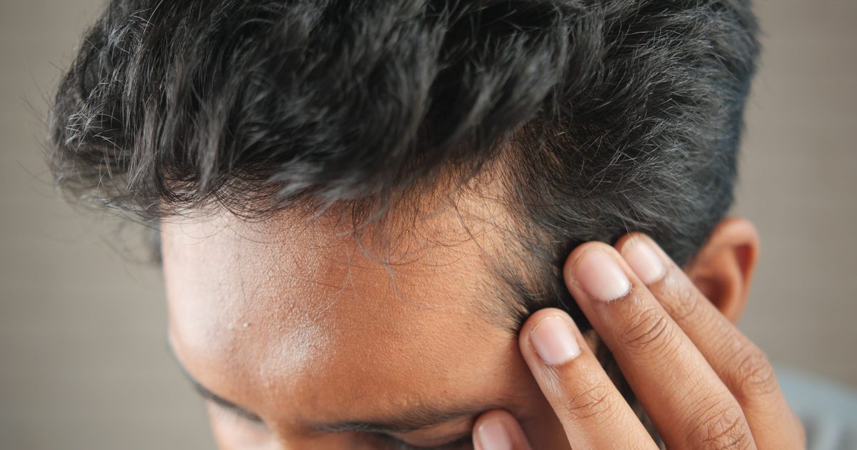 A close-up of a man's hairline, illustrating a common hair loss concern