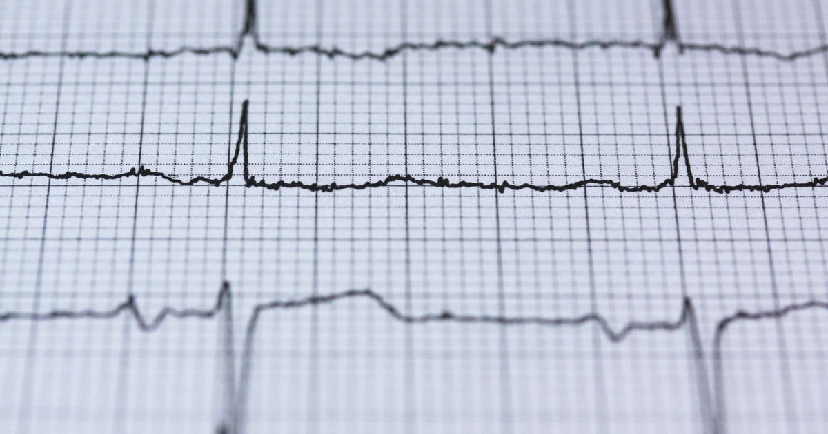 Close-up of an electrocardiogram printout showing heartbeat tracings on grid paper